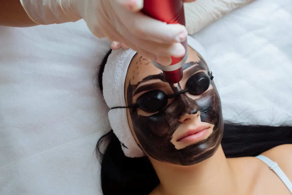 Carbon Peel Laser treatment for Oil Skin in Le Lotus