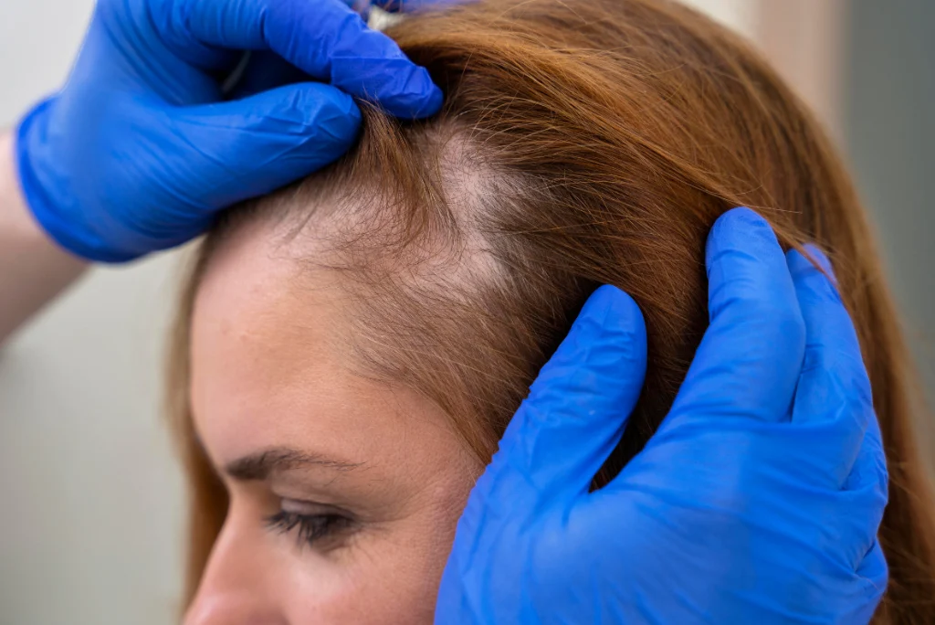 Alopecia Treatments in Pakistan