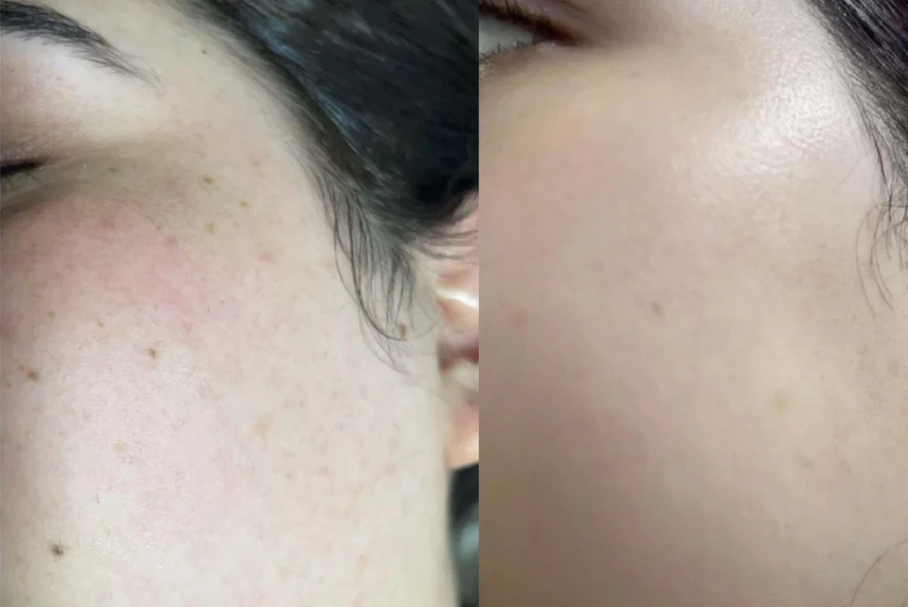 Mole Removal real comparison before and after in Le Lotus clinique Patient​