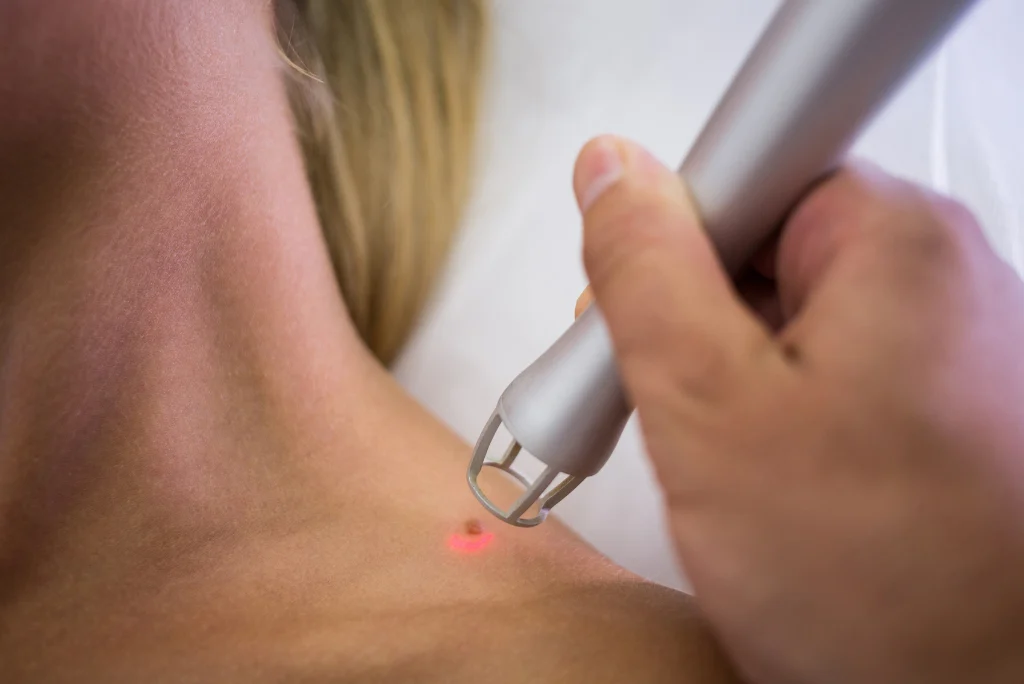 Laser Mole Removal Safe and secure treatment in Pakistan