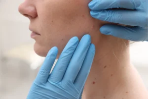 Laser Mole Removal in Islamabad complete Guide cost & safety