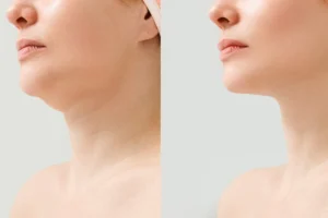 Double Chin Removal Treatment