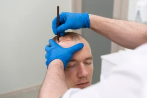 Scalp micropigmentation treatment at Le Lotus Clinique Pakistan