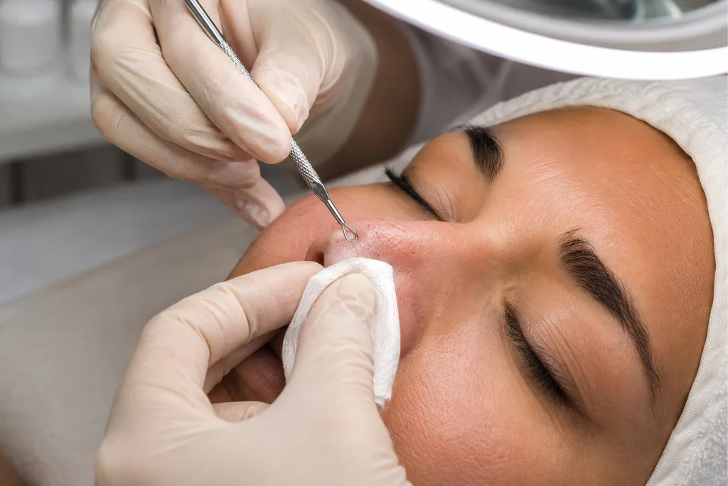 Open Pores Treatment in Pakistan Le Lotus Clinqiue