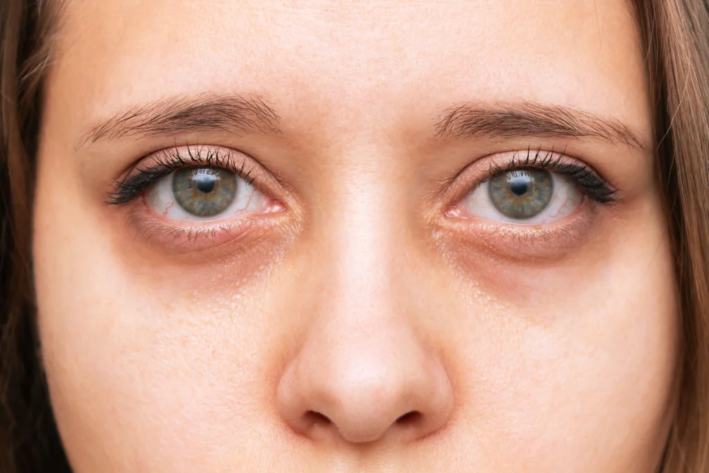 Dark circle treatment in Pakistan ( Le Lotus Clinique)