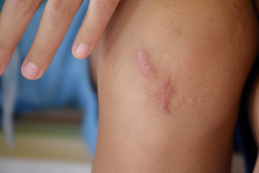 What is Keloid ?