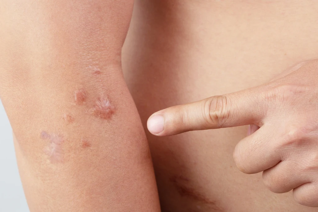 Keloid treatment